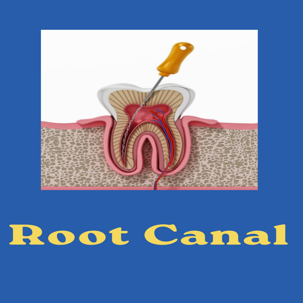 Root Canal