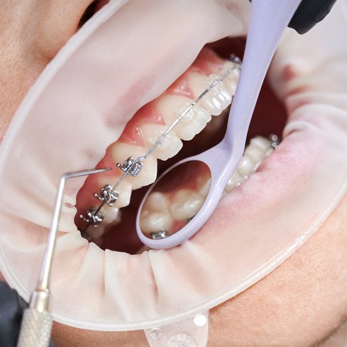 Braces & Aligners Treatment