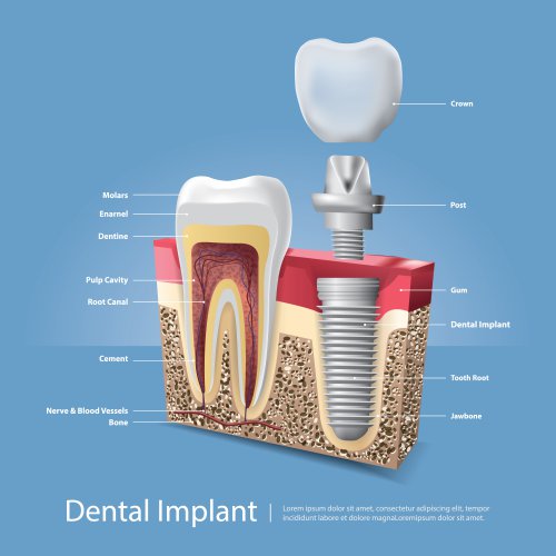 Dental Implants 